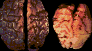 Brain of normal baby and brain of baby with FAS